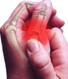 arthrose des mains traitement naturel