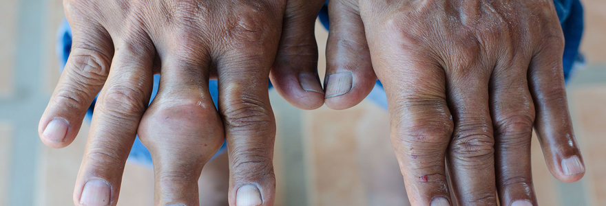 l’arthrose des doigts